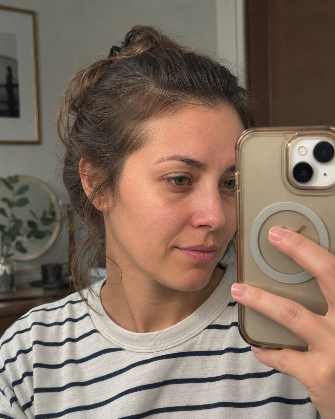 After — hairline restored