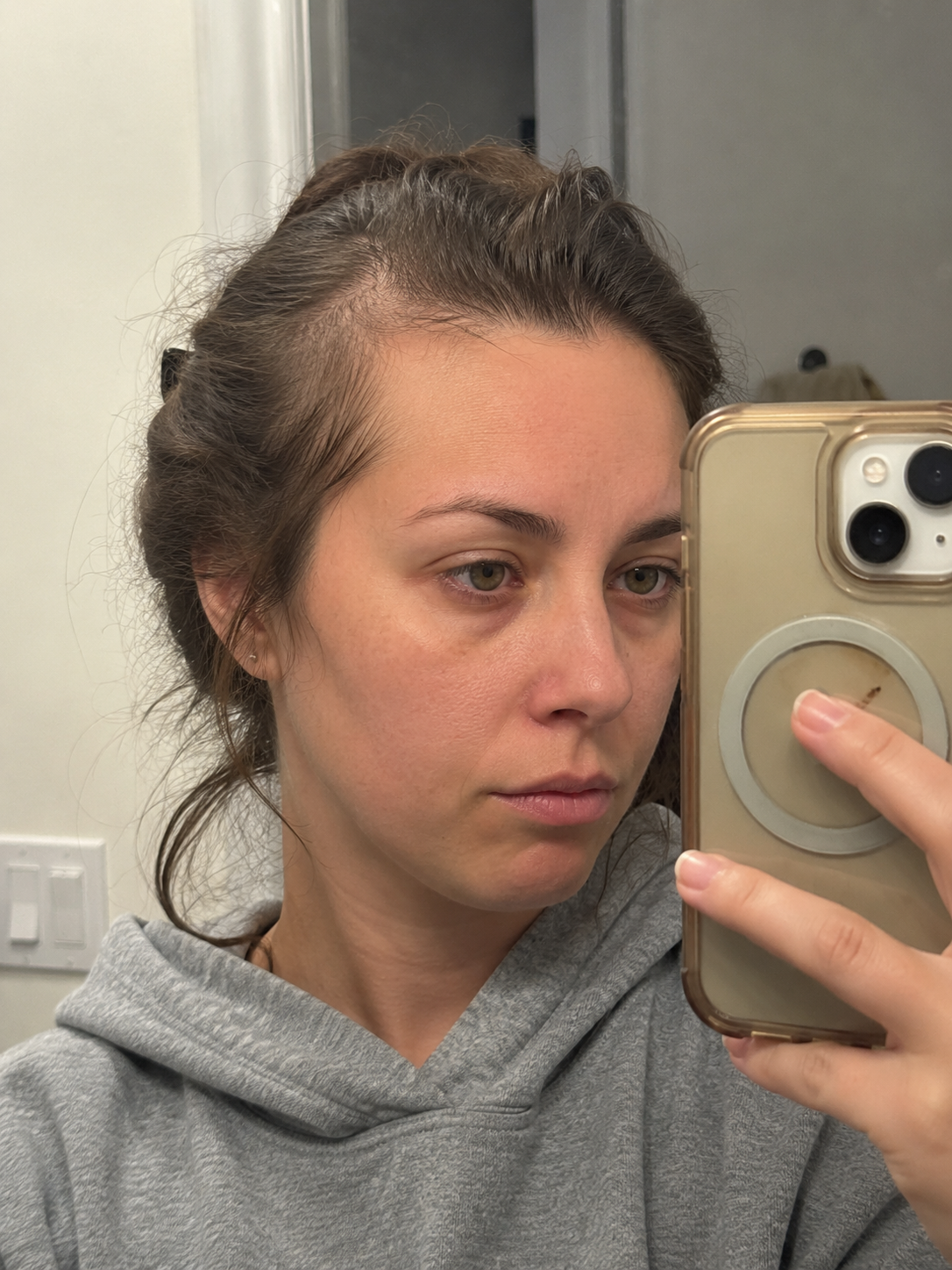 Before — hairline recession
