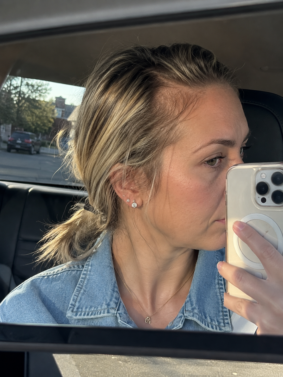 Before — thinning hairline